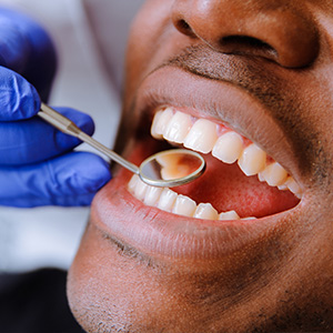 Dental Implants Dentist in Southern Pines NC