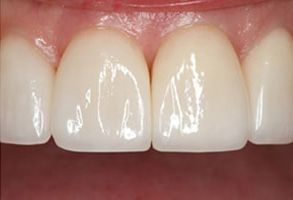 John F. Ceraso, DMD | Veneers, Dental Fillings and Periodontal Treatment