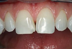 John F. Ceraso, DMD | Dental Bridges, Emergency Treatment and Night Guards